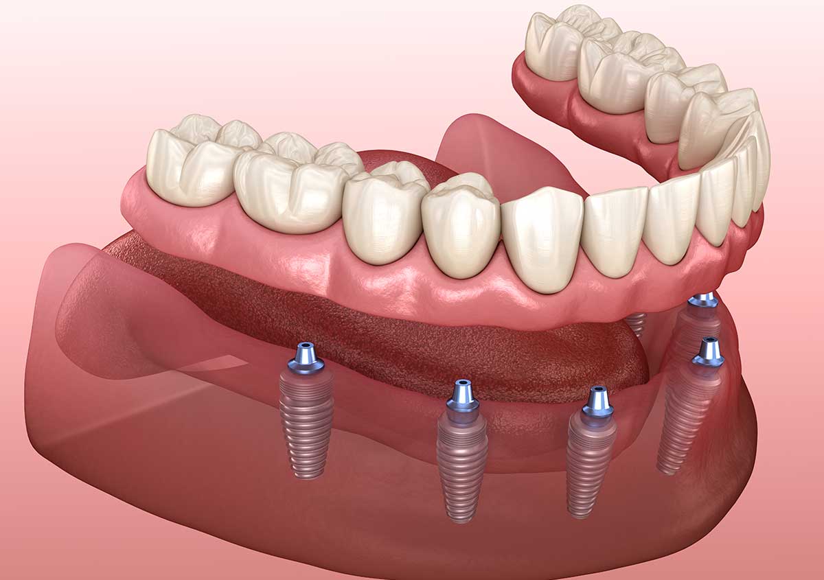 Implant Supported Dentures in Blaine WA Area