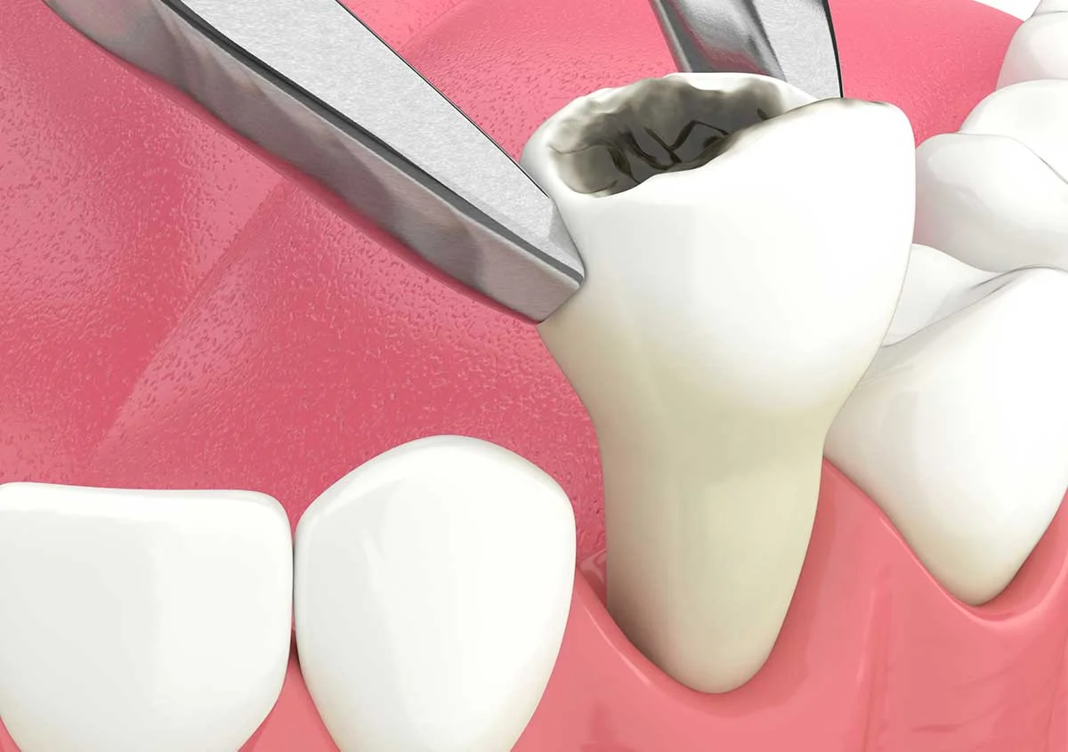 Understanding the Process Behind Affordable Tooth Extractions