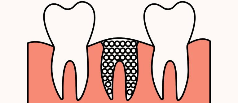 bone grafting for dental implants