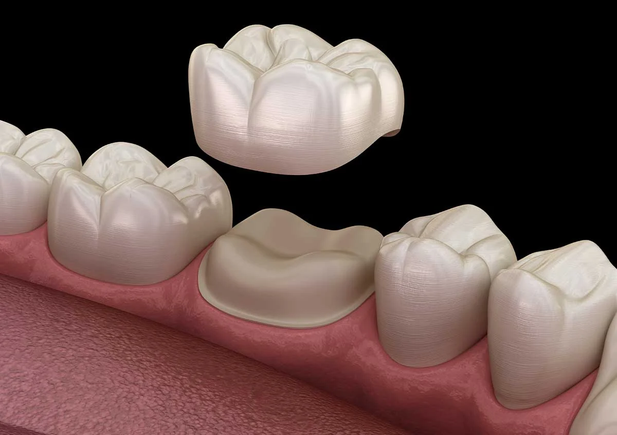 7 Ways Gold Crowns on Teeth Can Transform Your Smile