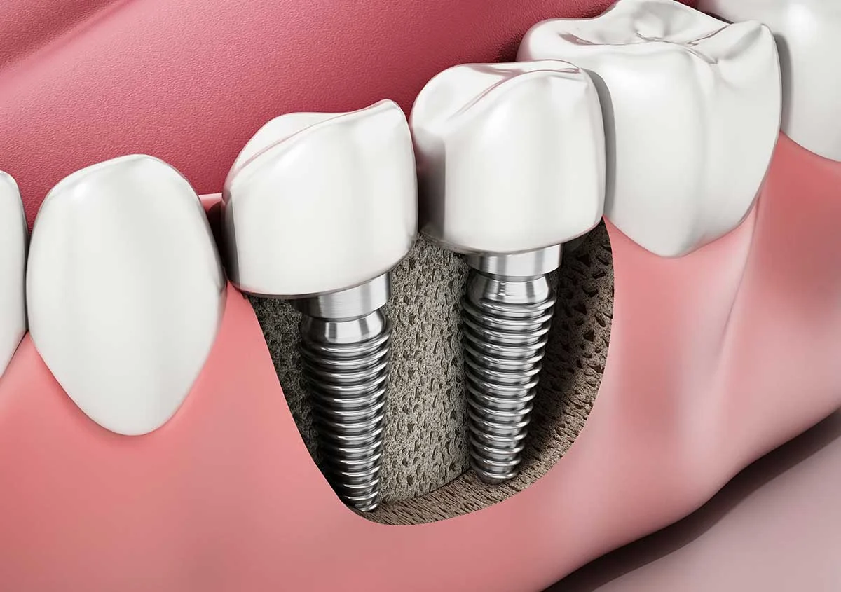 Permanent Dental Implants: 5 Ways They Save You Money in the Long Run