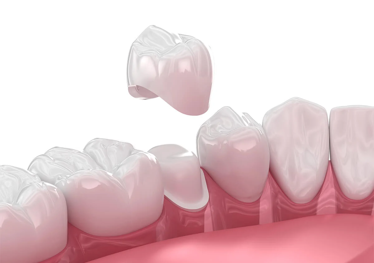 4 Benefits of Dental Crowns