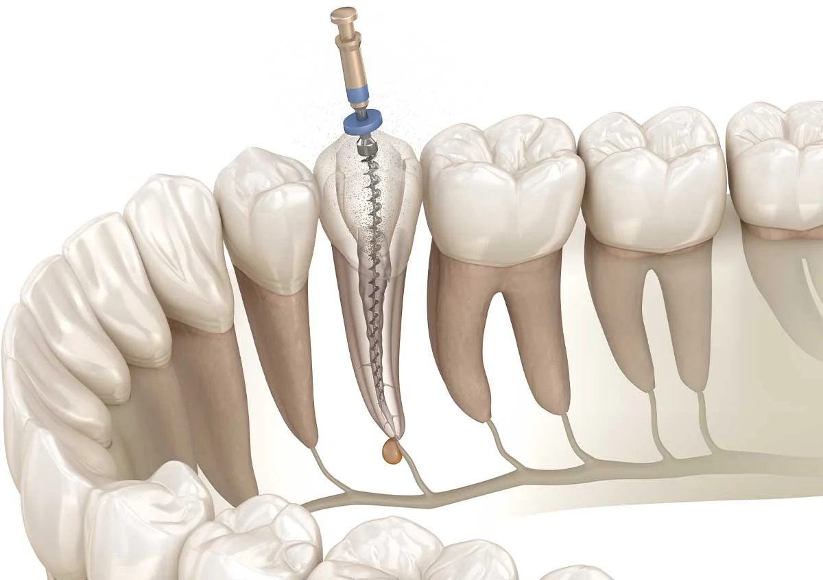 6 Benefits of Getting Root Canal Treatment for an Infected Tooth