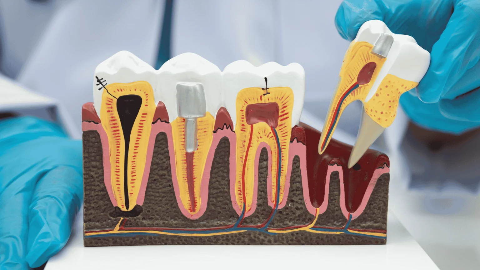 Root Canal vs. Tooth Extraction: Which Saves More in the Long Run?